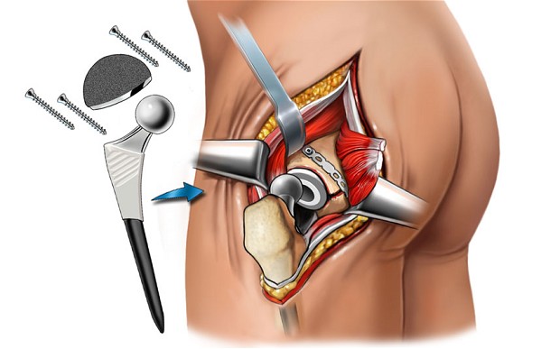 hip replacement and surgery 